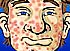 164-Acne Be Gone